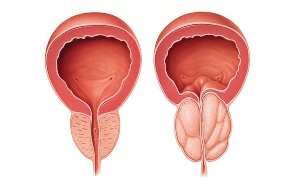 prostate normale et enflammée