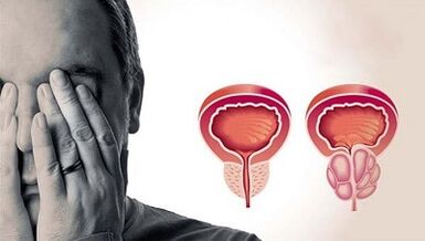 Les raisons du développement de la prostatite chez les hommes