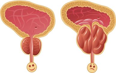 Prostate masculine saine et enflammée